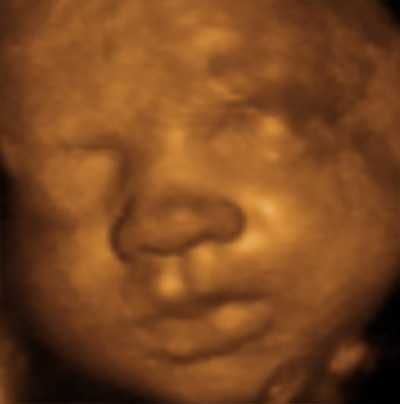 ultrasound